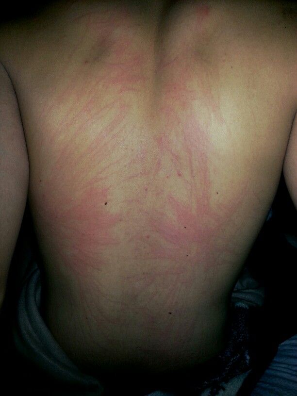 the back of a man's chest with red marks on it