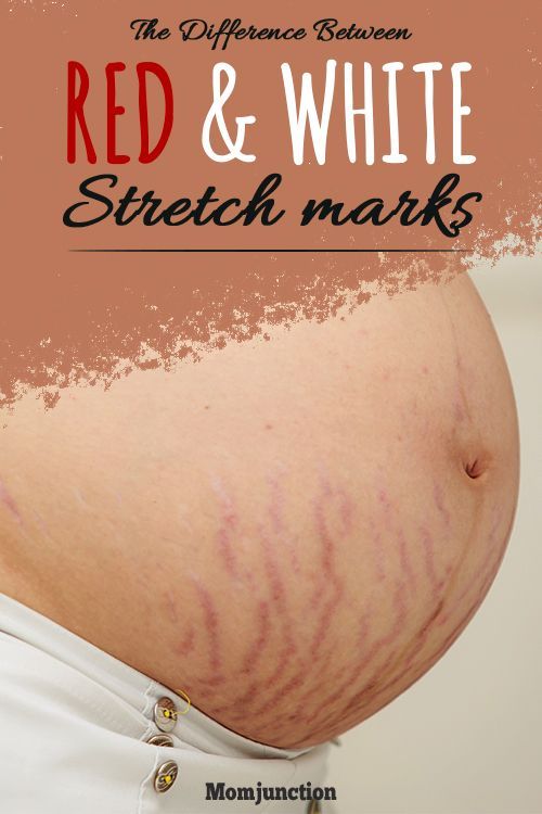 The Difference Between Red And White Stretch Marks : Usually, these marks appear on the belly, but they can also be found on breasts, thighs, hips, lower back and buttocks. #pregnancy #pregnancycare Strech Marks, Stretch Mark Remedies, Pregnancy Hacks, Marks Cream, Lotion For Oily Skin, Eye Rings, Stretch Mark Removal, Stretch Mark Cream, Healthy Advice