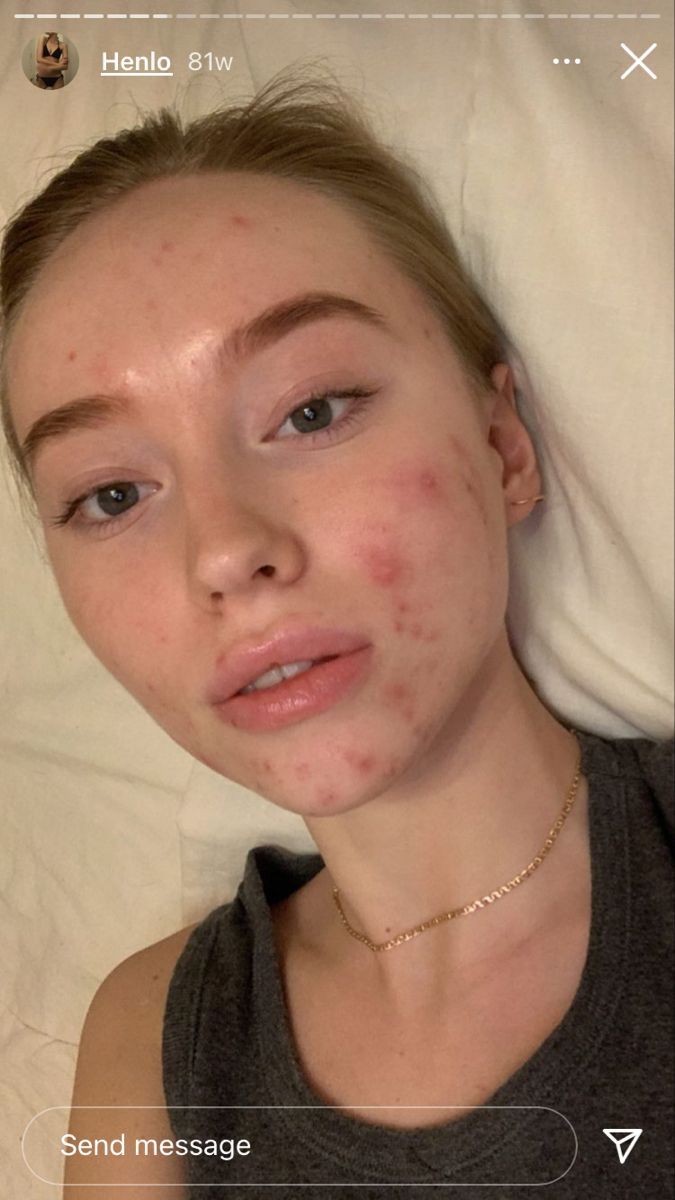 Acne Appreciation Aesthetic, Acne Face Aesthetic, People With Acne Pretty, Imperfect Skin Aesthetic, Accutane Aesthetic, Acne Aesthetic Girl, Makeup With Acne Showing, Pimples Aesthetic, No Makeup Acne