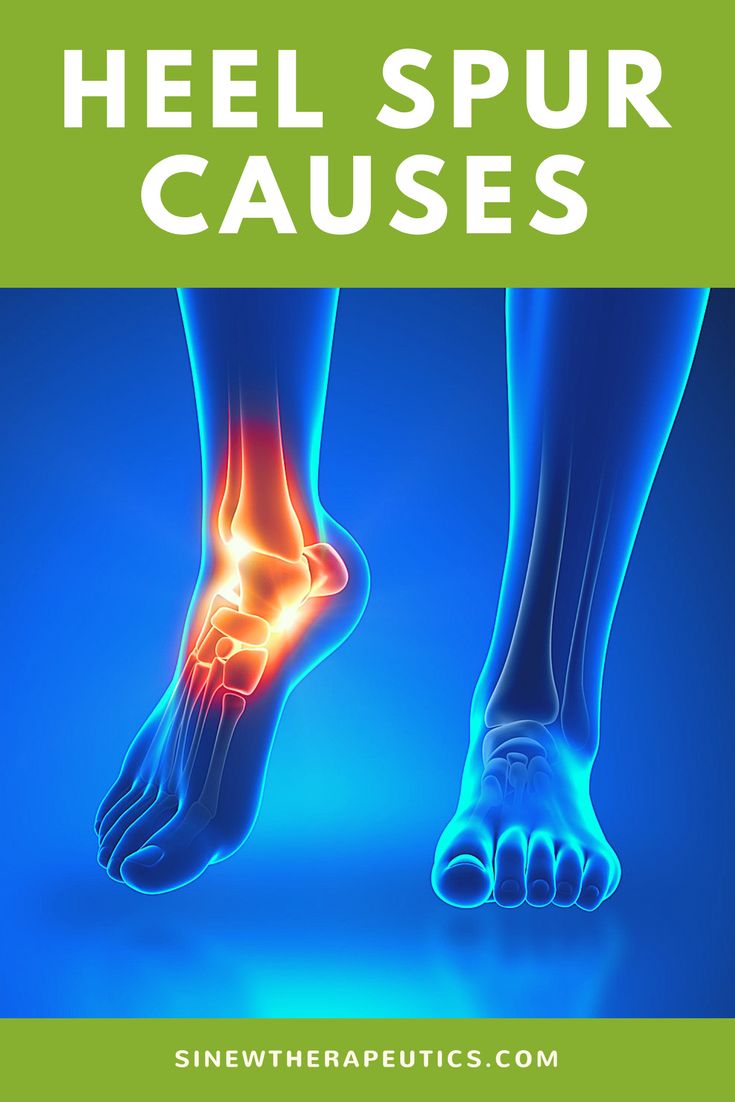 Bone Spur On Back Of Heel, Bone Spur Heel, Heal Pain Relief, Heel Spur Relief Remedies, Heal Spur Remedies, Heal Spurs, Heel Spur Relief, Heel Spur, Pain Relief Remedies