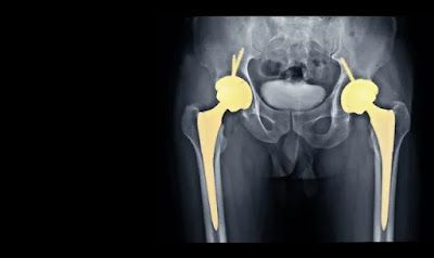 What I wish I knew before hip replacement surgery? Having a hip replacement surgery can be an intimidating experience. You may be wondering what the surgery entails, what to expect before and after, and what activities you should avoid to ensure a successful surgery. This article is here to provide you with the insight and advice you need before embarking on a hip replacement journey.We will discuss why it is important to know what to expect before hip replacement surgery, what to consider wh... Total Hip Surgery, Hip Surgery Recovery, Psoas Release, Hip Surgery, Surgery Recovery, Nerve Damage, Alternative Treatments, Post Surgery, Hip Workout