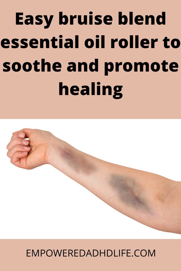 Feel good about having something to hand to your sensitive kiddo to help bruises feel better and heal fast. Essential Oils For Bruising, Oils For Bruising, How To Heal Bruising Fast, Remedies For Bruising, How To Help Bruising, Doterra Bruising Blend, Essential Oils For Wound Healing, Essential Oil For Bruising, Cypress Oil