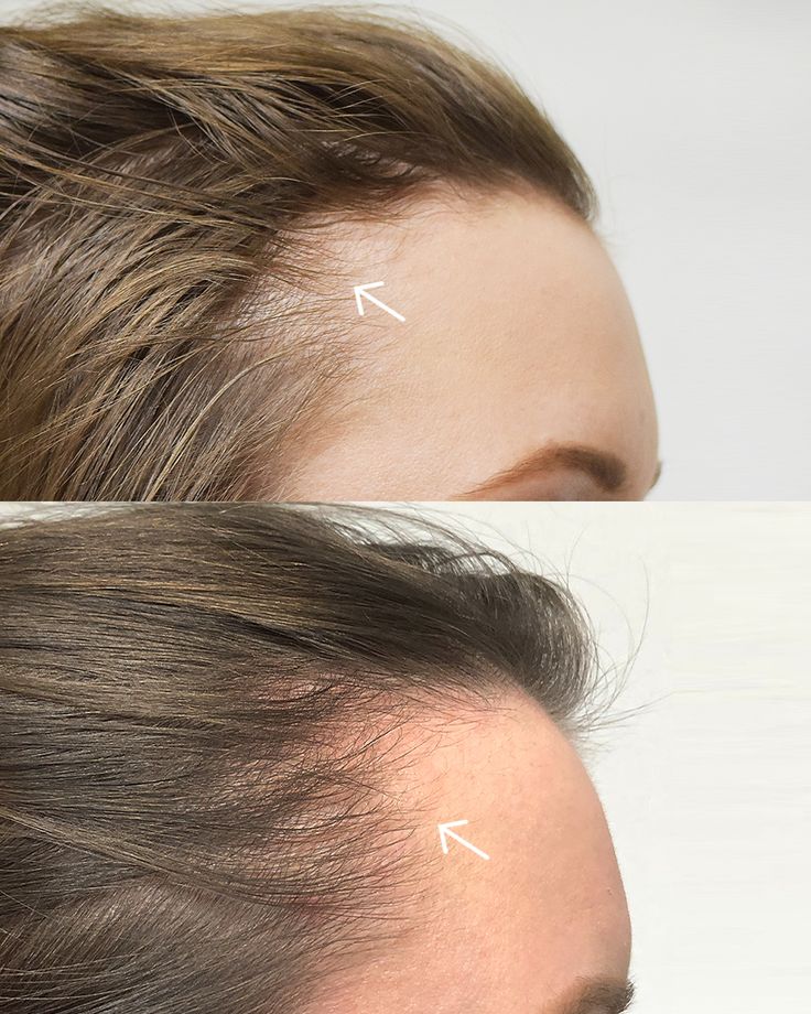 HD-PRP   Results shown after 6 weeks  PRP has become a mainstay for slowing hair loss and growing new hair for both men and women, but High Density (HD) PRP has become the new standard thanks to Dr. Welter and the pioneering research of the Regeneris team.   #photofacial #bostonlaser ⁠#botoxboston #fillersboston #lipfiller #medspa #wrinkles #neckwrinkles #hairlosswomen #hairlosstreatment #hairlosssolutions #hairloss Prp For Hair, Prp Hair, Biotin Hair Growth, Fast Hair Growth, Biotin Hair, Beauty Video Ideas, Skin Aesthetics, Fast Hair, Beautiful Gray Hair