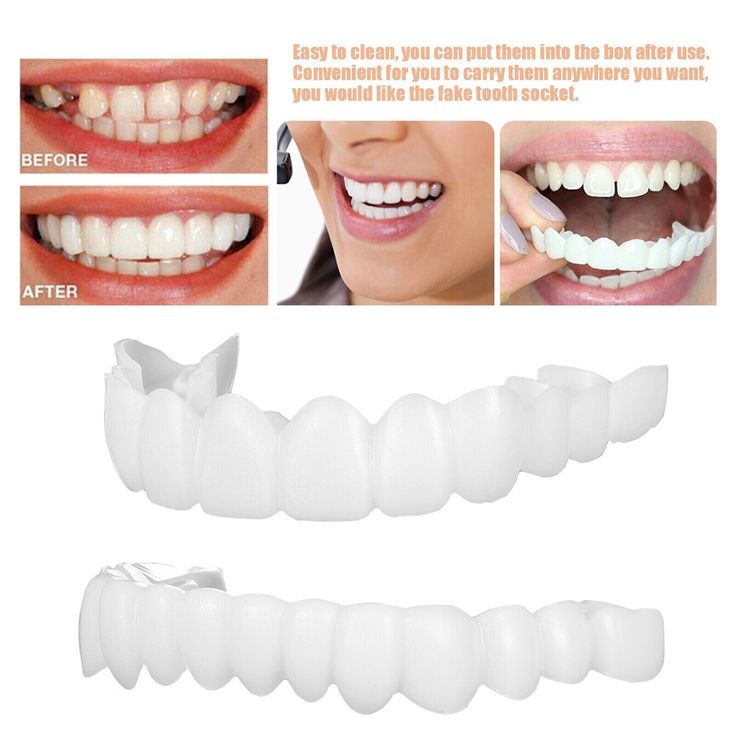 Features: 1. What's Included In The Package: 1 x Upper Fake Teeth, 1 x Lower Fake Teeth, 1 x Box, meeting your daily using needs. 2. Safe To Use: Veneers teeth are made of reliable material, no bad smell, are not easy to rust or break, with a smooth surface, and are comfortable to wear, serving you for a long time is not a big problem 3. Show Your Shiny Smile: The fake white teeth will help cover your missing, bent, or broken teeth, looking natural and real, just wear them and smile at your will Fake Braces, Broken Teeth, Teeth Covers, Tooth Repair, Veneers Teeth, False Teeth, Fake Teeth, Loose Tooth, Teeth Braces