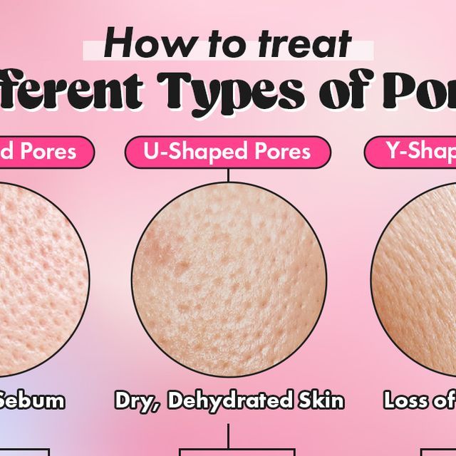 Stylevana | K-Beauty on Instagram: "Don't let your pore-blems get you down!😆 To understand how to treat your pores effectively, use our guide to determine your pore shape + the best ingredients to solve your skin concerns! No matter the pore shape or skin texture, the APLB, @haruharuwonder_official + more collection is on the case to get your skin back to a smoother, soothed state😌 Act quick before it gets out of hand and shop the stash ASAP at the 🔗 in the bio!🛍️  🔍APLB - Salicylic Acid BHA Arbutin Ampoule Serum - 40ml 🔍numbuz:n - No. 3 Skin Softening Serum - 50ml 🔍Haruharu WONDER - Black Rice Hyaluronic Toner - Fragrance Free - 150ml 🔍medicube - Zero Pore Pad 2.0 - 70pcs 🔍SOME BY MI - Retinol Intense Reactivating Serum - 30ml 🔍KSECRET - SEOUL 1988 Serum : Retinal Liposome 2% + Pores On Face How To Get Rid Of At Home, Reduce Pores On Face, How To Close Pores, Retinol Intense, Get Rid Of Pores, Korean Serum, Facial Massage Techniques, Haruharu Wonder, Big Pores