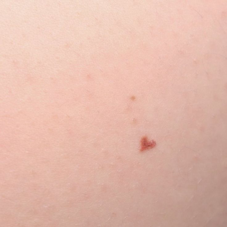 the back of a woman's head with brown spots on her left arm and chest