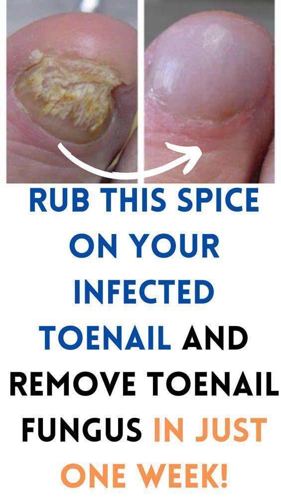 Infected Toenail, Toenail Health, Toenail Fungal Infection, Nail Remedies, Toenail Fungus Remedies, Nail Fungus Remedy, Nail Work, Nail Infection, Fungal Nail