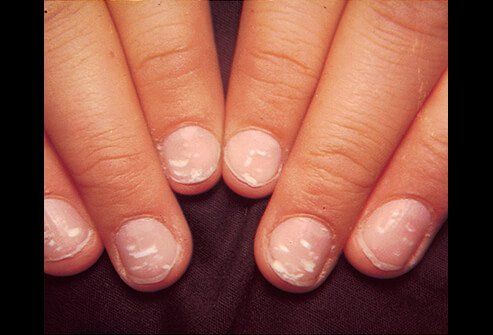 Picture of Leukonychia Striata White Dots On Nails, White Marks On Nails, White Spots On Nails, Emerald Nails, White Acrylic Nails, White Patches, White Mark, Black Nails, French Nails