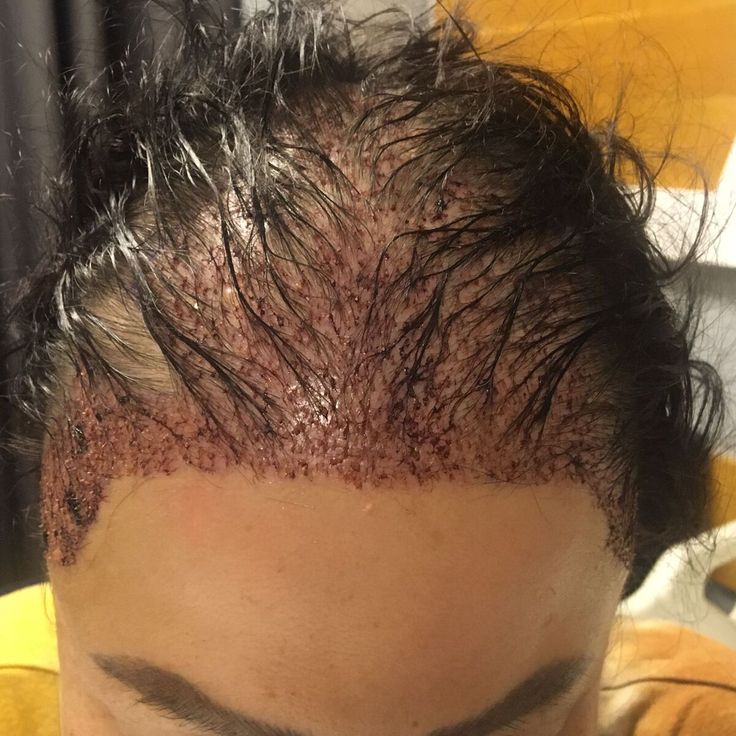 Unshaven FUE Hair Transplant did by Dr Tas at Tas Hair Clinic Istanbul, Turkey Female Hair Transplant, Hair Transplant Women, Hair Transplant Cost, Female Pattern Baldness, Fue Hair Transplant, Hair Clinic, Female Hair, Hair Transplant, Abaya Fashion