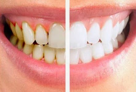 Remove Dental Plaque - Tips to Removing Plaque Zoom Whitening, Plaque Teeth, Homemade Toothpaste, Teeth Whitening Remedies, Laser Teeth Whitening, Teeth Bleaching, Pasta Dental, Porcelain Veneers, Dental Veneers