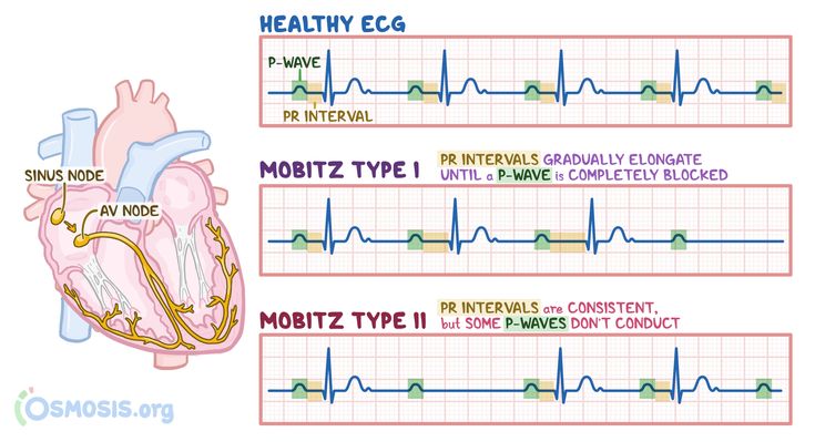 Mobitz type I is a type of 2nd degree AV block, which refers to an irregular cardiac rhythm (arrhythmia), that reflects a conduction block in the electrical conduction system of the heart Pr Interval, Cardiac Rhythms, Calcium Channel Blockers, P Wave, Nursing School Essential, Nurse Study Notes, Cardiac Nursing, Heart Blocks, Medicine Student