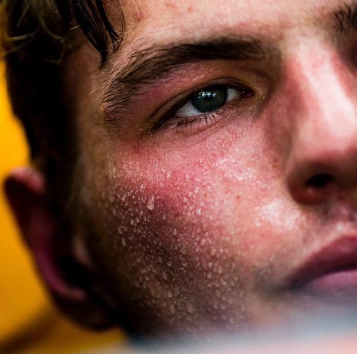 a young man with freckles on his face and eyes looking at the camera