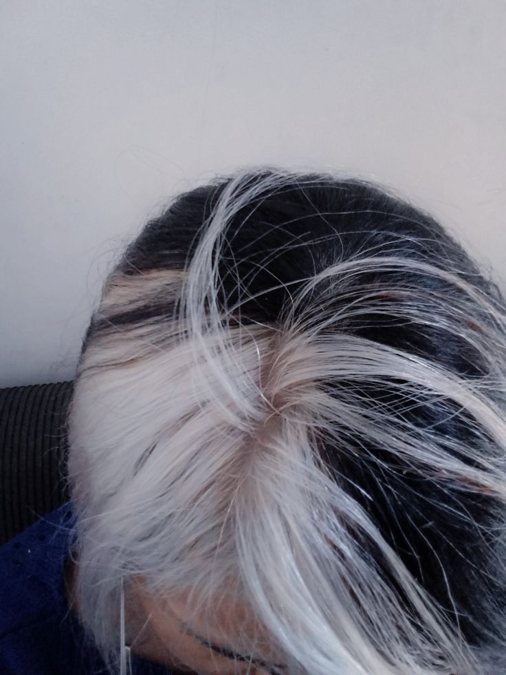 White Patch Of Hair, White Birthmark Hair, Poliosis Hair Aesthetic, White And Black Hair Aesthetic, Platinum Hair Black Women, Hair Birthmark, Black And White Hair Aesthetic, Poliosis Hair, Blonde Hair With Black Roots