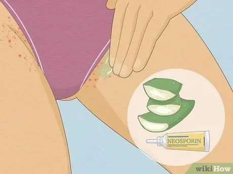 How To Get Rid Of Hair Bumps Down There, Best Home Remedy For Razor Bumps, How To Get Rid Of Inner Thigh Bumps, Natural Remedies For Razor Bumps, Get Rid Of Shaving Bumps Bikinis, How To Get Rid Of Bumps On Private Area, What Helps With Razor Bumps, Why Do I Get Razor Bumps, Treating Razor Bumps Bikinis