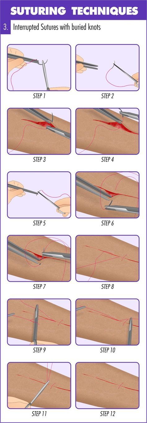 the procedure is shown with instructions on how to use needles and threading needles