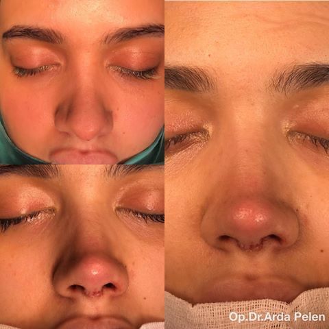 Eyebrow Growth Oil, Nose Plastic Surgery, Nose Surgery Rhinoplasty, Nose Job Inspo, Natural Eyebrows Growth, Ethnic Rhinoplasty, Nose Fillers, Dream Nose, Rhinoplasty Nose Jobs