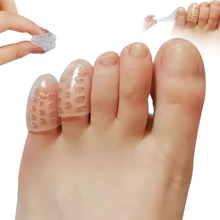 PRICES MAY VARY. 【Silicone Anti-friction Toe Protector】:--- If your toes are sore from corns, blisters, calluses, or a broken toe, you need cushioning to help relieve the pain so you can stay active at home and at work. 【High Quality Material】:--- Made of latex-free medical-grade silicone material, the toe pads are soft and elastic, easy to put on and take off. They are washable and reusable. 【Transparent Design】:--- Since they are see-through, they are virtually invisible when walking, so don't Gel Toes, Ingrown Toe Nail, Medical Grade Silicone, Foot Health, Latex Free, Pharmacy Gifts, Toe Nails, Beauty And Personal Care, Health And Wellness