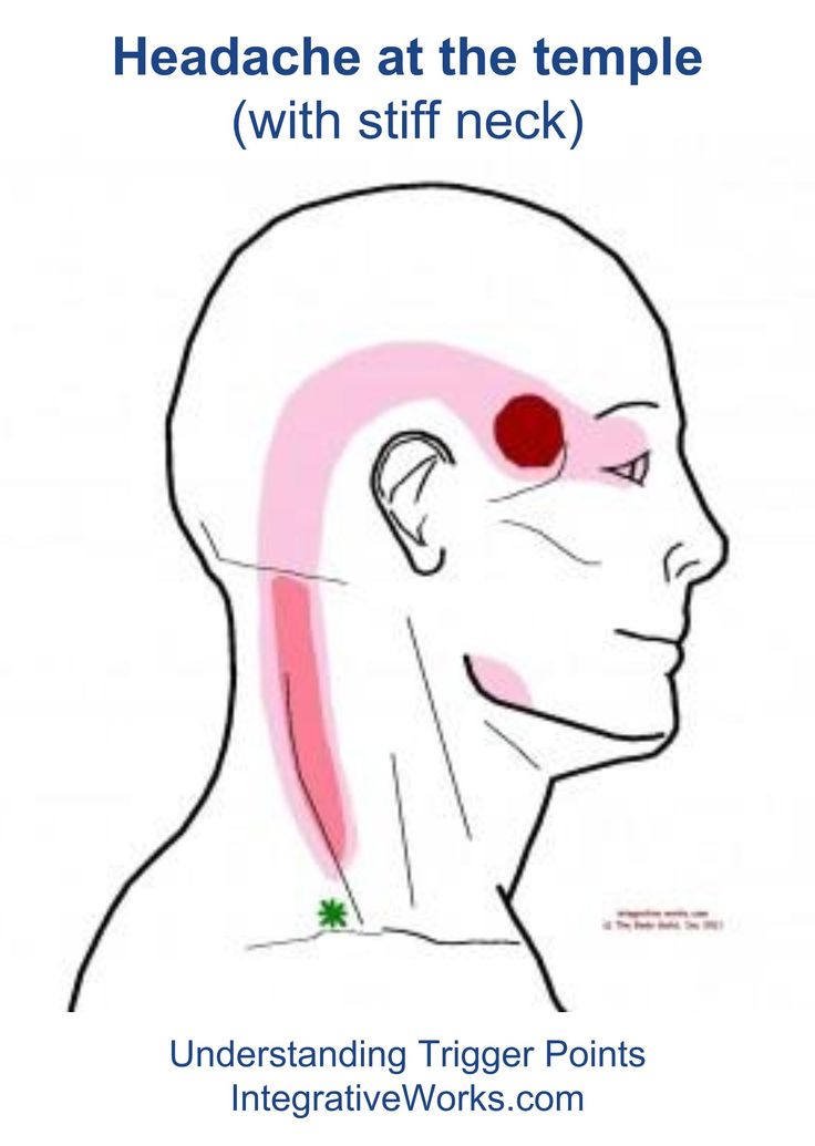 Headache Meaning, Punkty Spustowe, Massage Points, Anatomy Physiology, Trigger Point Therapy, Stiff Neck, Trigger Point, Chronic Migraines, Migraine Relief