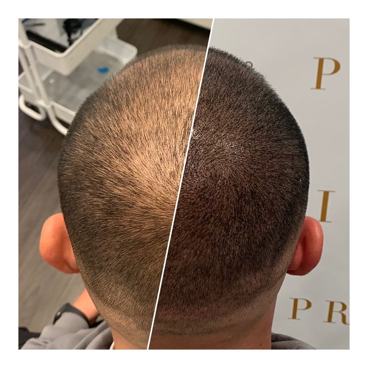 Micro Scalp Pigmentation, Hair Growth Techniques, Hair Replacement For Men, Hair Pigmentation, Scalp Tattoo, Rancho Cucamonga California, Timeless Tattoo, Scalp Micropigmentation, Taper Fade Haircut