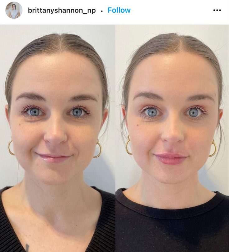 Lip Injections On Small Lips, Lip Injections Small Lips, Lip Filler Before And After Small Lips, Natural Lip Fillers Small Lips, Lip Filler Before And After Juvederm, Natural Lip Fillers Before And After, Lip Filler On Small Lips, Subtle Lip Filler Before And After, Lip Filler Natural