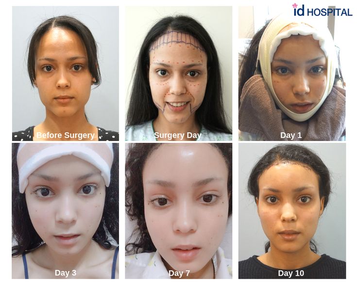 Xiomary had a total transformation at ID Hospital. She had V-line surgery, forehead reduction, fat6 graft and thread lift. #idhospital #idhospitalkorea #plasticsurgery #koreanplasticsurgery #surgeryinkorea #facialcontouring #koreanplasticsurgerybeforeandafter #Vlinesurgery Forehead Reduction Surgery, Forehead Reduction, Hospital Surgery, Face Plastic Surgery, V Line Surgery, Small Forehead, Forehead Lift, Korean Plastic Surgery, Plastic Surgery Photos