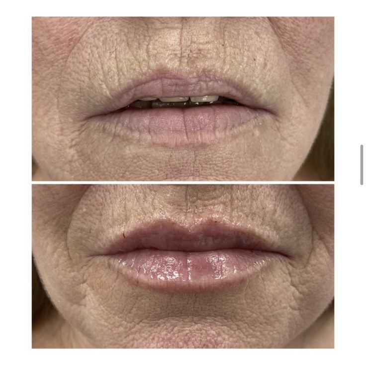 Before and after lip filler, we gave this lovely patient some volume and kept her lips looking natural Lip Filler Shape Ideas, 1ml Lip Filler, Shape Ideas, Lip Filler, After Pictures, Natural Lip, Love Natural, Lip Fillers, Before And After Pictures