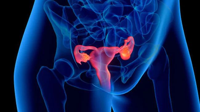 Ovarian Pain: Possible Causes, Diagnosis, and Treatments Ovarian Pain, Ovary Pain, Endocrine Disorders, Polycystic Ovaries, Types Of Cancers