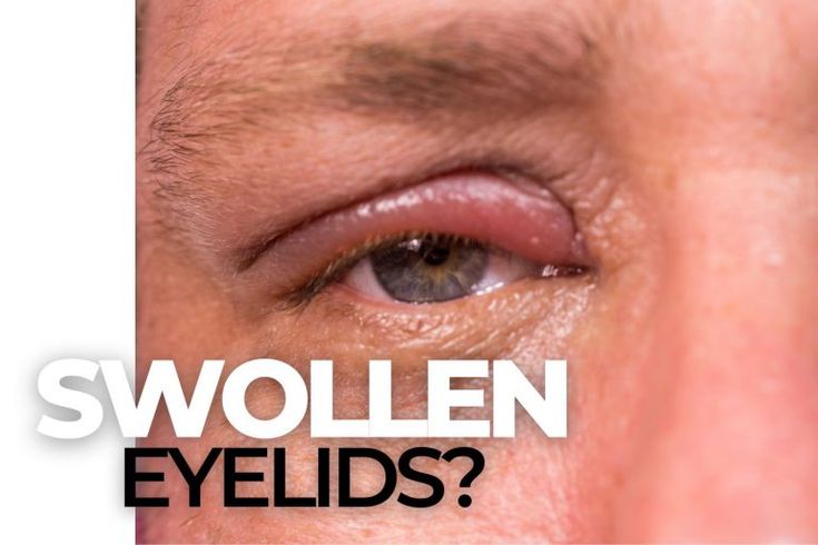 ￼Blepharitis: The Most Common Cause of Dry Eye - EZOnTheEyes Swollen Eyes Remedy, Conjuctivita Eye, Dry Eyelids Remedy, Swollen Eyes From Allergies, Sty In Eye Remedies, Eye Infection Remedies, Stye Remedies Fast, Swollen Eyelids Remedy, Swollen Eye Remedies