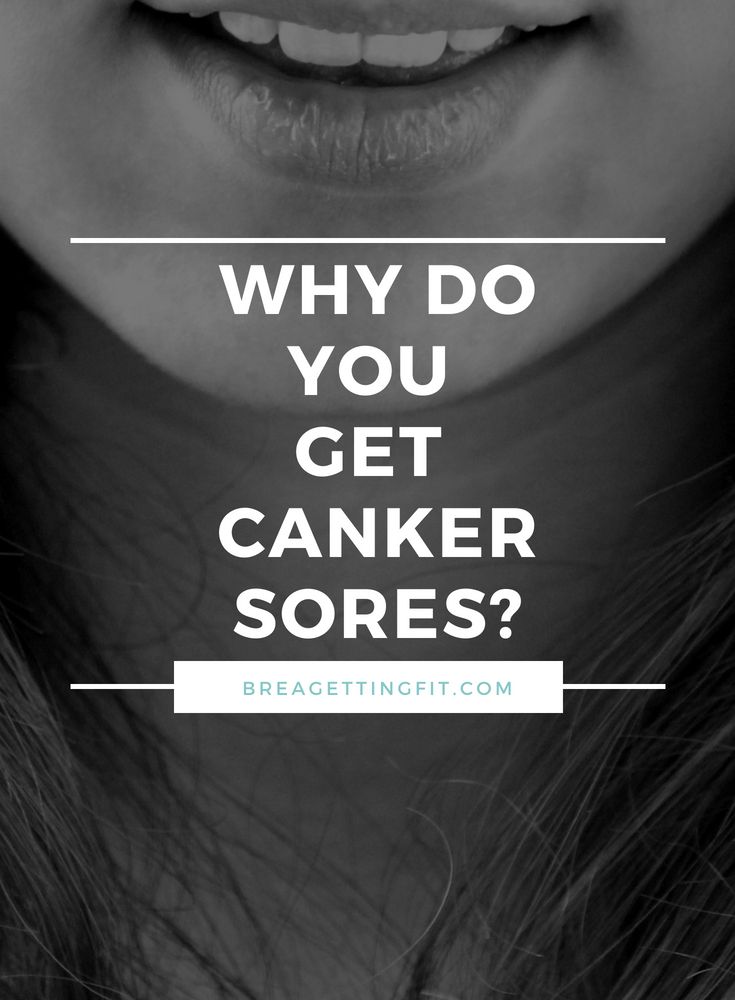 Blister In Mouth, Canker Sore On Tongue, Canker Sore Causes, Ulcer On Tongue, Gum Sores, Canker Sore Relief, Mouth Blisters, Ulcer Remedies Mouth, Canker Sore Remedy