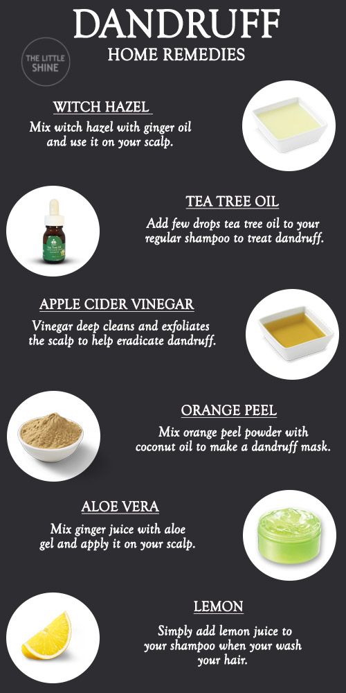 Alovera For Dandruff, How To Get Rid Of Hair Dandruff, How To Deal With Dandruff Dry Scalp, Get Rid Of Dandruff Naturally, Dandruff Remedy Diy How To Get Rid, What Helps With Dandruff, Instant Dandruff Removal, Best Remedy For Dandruff, Causes Of Dandruff