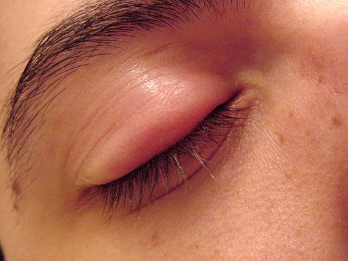 Swollen Eye Swollen Eyelids Remedy, Swollen Eye Remedies, Stye Remedy, Eye Stye Remedies, Swollen Eyelid, Warts Remedy, Swollen Eyes, Puffy Eyes, Moisturizing Body Wash