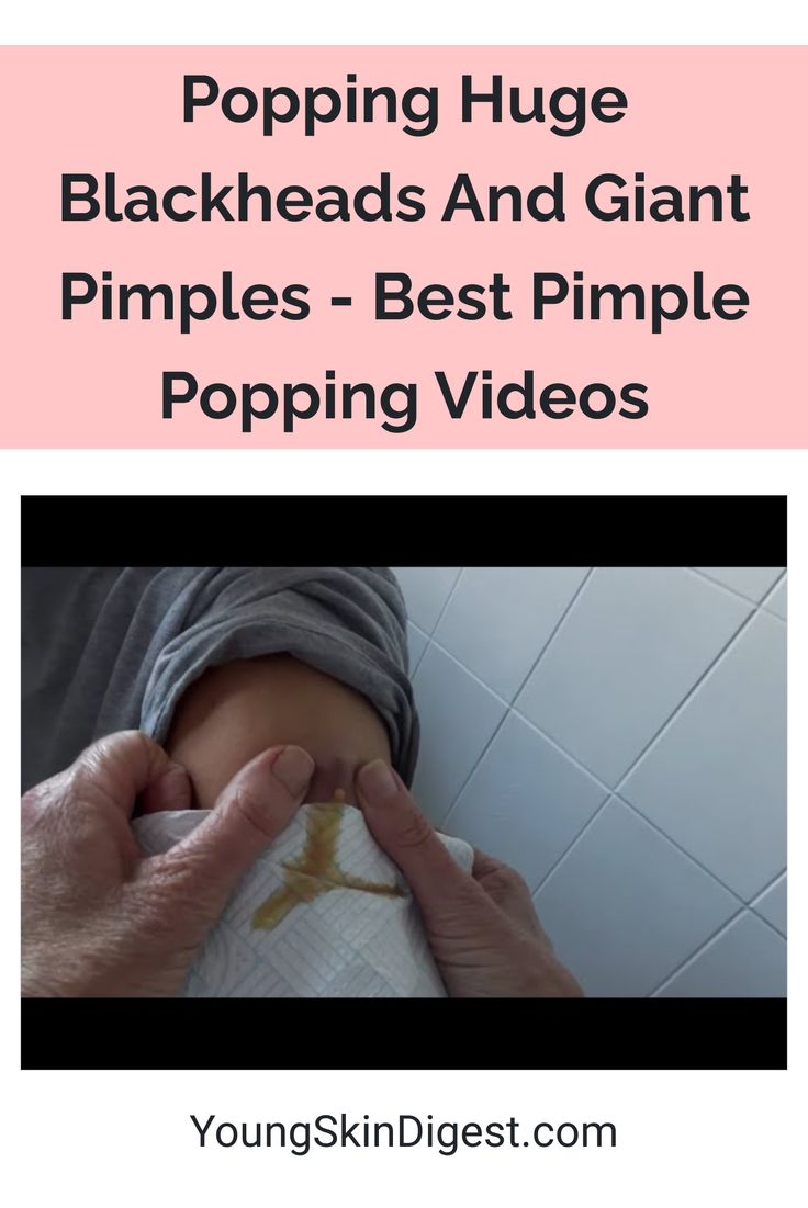 Popping Huge Blackheads And Giant Pimples - Best Pimple Popping Videos Pimple Poppìng Videos New, Pimple Poppìng Videos, Pimple Poppìng, Acne Recipes, Huge Blackheads, Video New, Radiant Skin, Blackheads, Acne