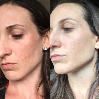 MUAC Testimonials Page:  After two pregnancies, my melasma was making me e... Chemical Peel At Home, Tretinoin Cream, Rid Of Blackheads, Lip Line, Clear Skin Tips, Perfect Skin Care Routine, Get Rid Of Blackheads, Easy Yoga Workouts, Peeling Skin