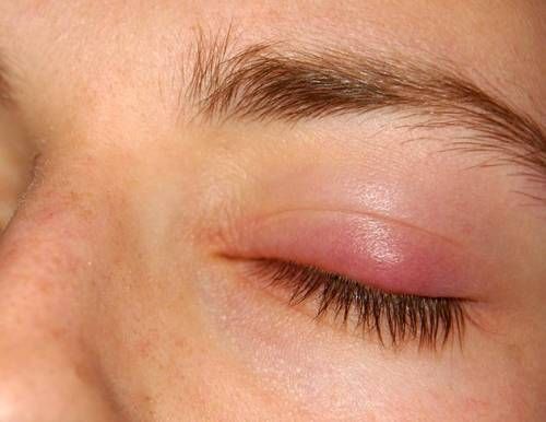 Eye Inflammation Remedies, Swollen Eyes Remedy, Eye Allergies Remedies, Swollen Eyes From Allergies, Bump On Eyelid, Stye Remedies Fast, Swollen Eyelids Remedy, Swollen Eye Remedies, Stye Remedies