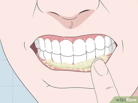 3 Simple Ways to Treat a Gum Infection - wikiHow Sore Gums Remedy, Swollen Gums Remedy, Gum Sores, Reverse Receding Gums, Remedies For Dry Mouth, Dental Routine, Dental Infection, Tooth Infection, Gum Inflammation