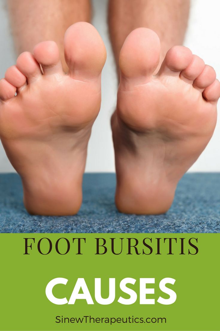 The type of shoes worn during high-impact running, walking, and jumping activities can play a role in foot bursitis since inappropriate shoes increase the amount of shock the bursa must absorb. Learn more about Foot Bursitis at SinewTherapeutics.com Facitis Plantar, Foot Pain Relief Remedies, Plantar Fascitis, Pain Relief Remedies, Foot Injury, Foot Pain Relief, Joints Pain Relief, Heel Pain, Foot Pain