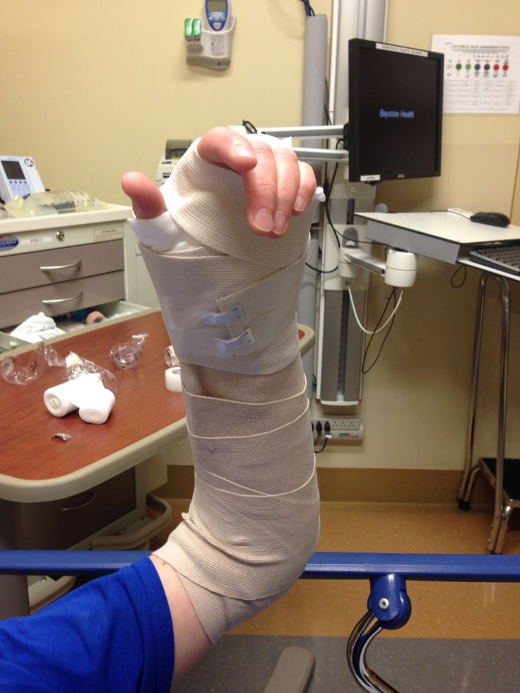 a person with a cast on their leg in a hospital room, holding onto the arm