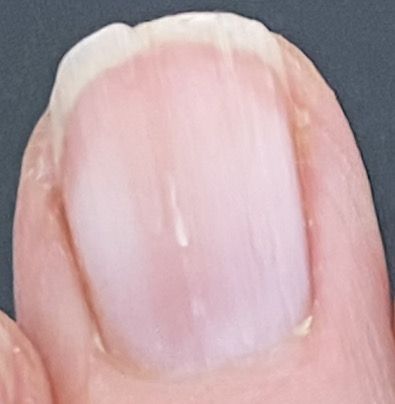 Repair Split Nail, Split Fingernails Remedies, How To Stop Nails From Splitting, Nail Splitting Remedies, Nail Splitting Down The Middle, How To Fix A Split Fingernail, Splitting Nails Remedies, Nail Ridges Vertical Warning Signs, Finger Nails Health