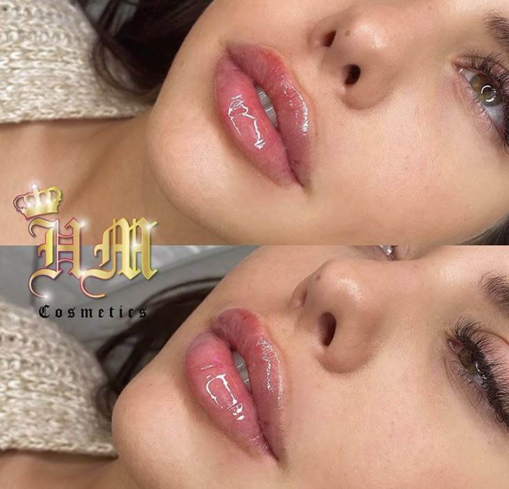 Different Types Of Lip Fillers, Angelina Jolie Lip Filler, Lip Filler Shape Ideas Pouty, Russian Lips Filler 1ml, Lip Filler 1 Ml, Lip Filler Inspiration 1ml, Lipfiller 1ml, Lip Fillers Before And After 1ml, Lip Filler Before And After