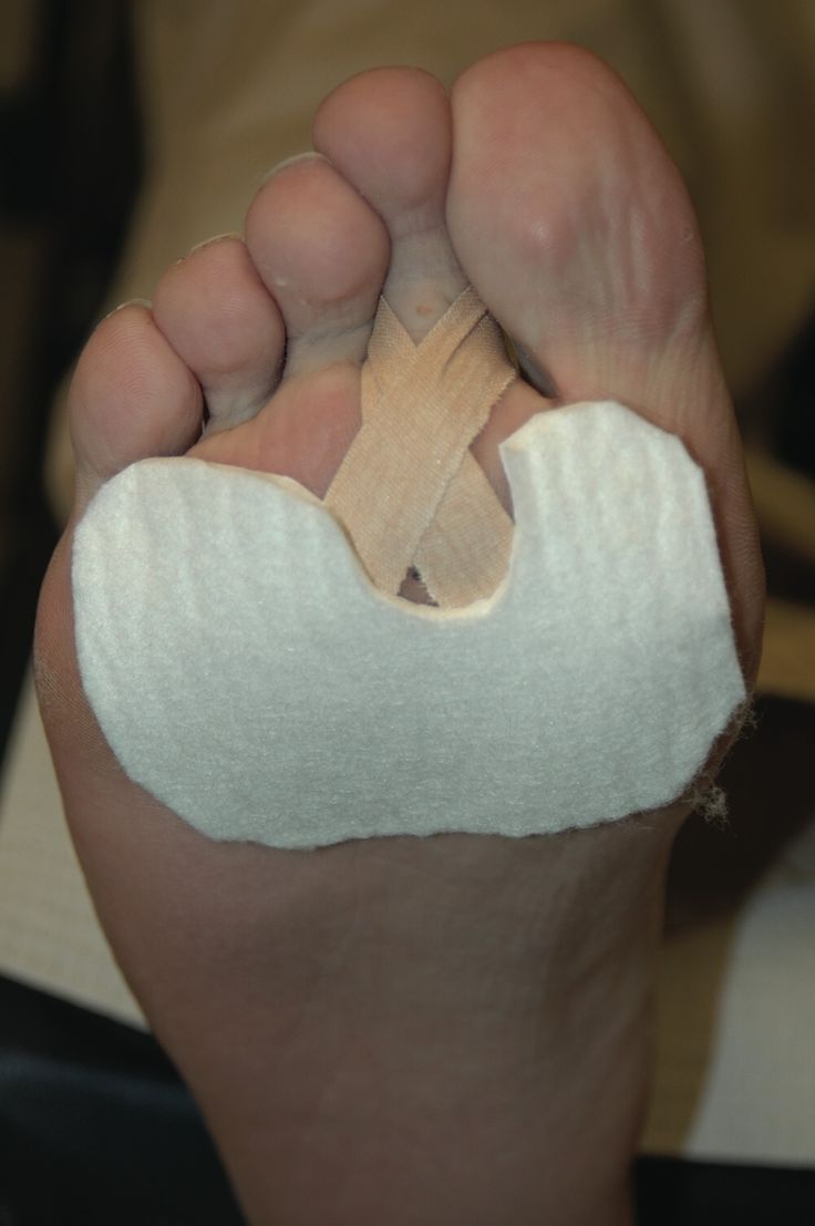 Plantar Plate Tear, Facitis Plantar, Foot Pain Relief Remedies, K Tape, Morton's Neuroma, Pain Relief Remedies, Foot Pain Relief, Foot Health, Foot Pain