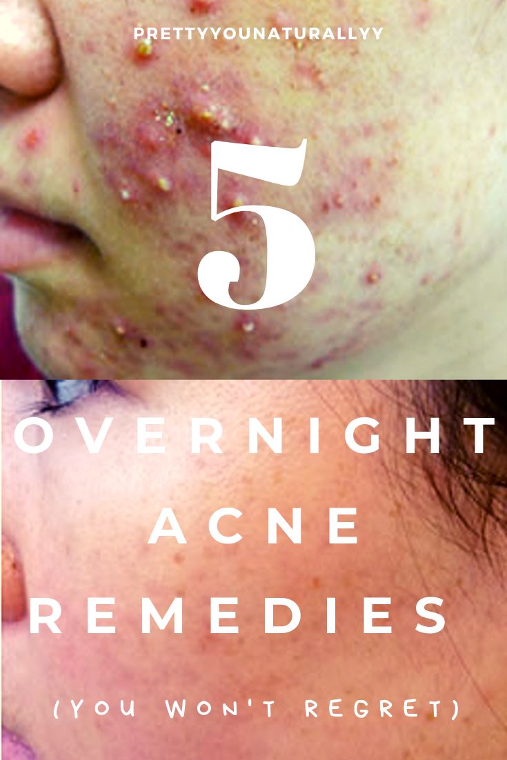 Clear Acne Overnight, Back Acne Remedies, Face Acne Treatment, Overnight Acne Remedies, Acne Clearing, Forehead Acne, Acne Overnight, Bad Acne, Pimples Overnight