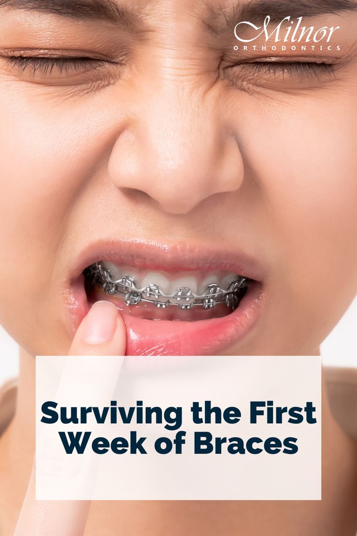 Surviving the First Week of Braces Clear Bands On Braces, Braces Care Kit, Things To Eat After Getting Braces, Things To Eat When You Have Braces, Braces Kit Survival, How Are Braces Applied, Life With Braces, What To Eat After Braces, Foods To Eat After Braces