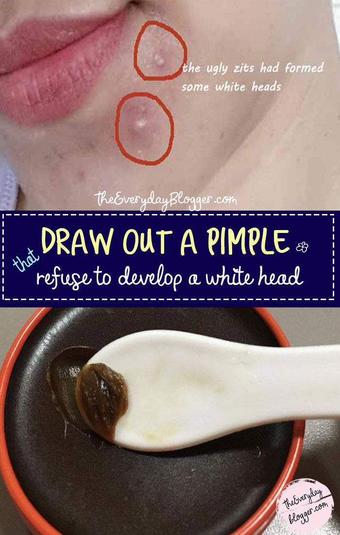 #DrawOutaPimple - A blind pimple is an under the skin pimple with no head, this remedy will help to flush the area and draw the pimple to the surface of the skin & is ready to be drained without much effort. Ingrown Pimple, Deep Pimple, Zit Remedy, Painful Pimple, Drawing Salve, Cystic Pimple, Blind Pimple, Pimples Under The Skin, Pimples Overnight