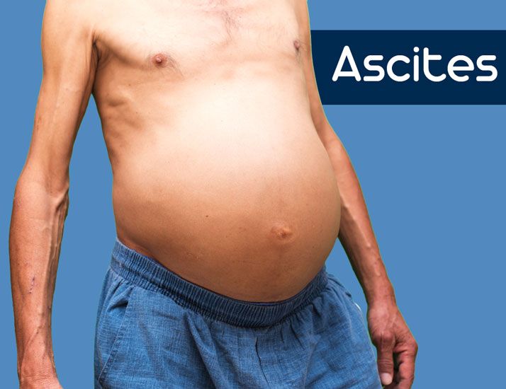 #Ascites is an accumulation of protein-containing (#ascitic) #fluid within the #abdomen. It is considered a frequent complication at the last stage of #liver #disease as well as other fluid #retention conditions like peripheral #edema. The fluid accumulated may also travel to the chest and cause difficulty in #breathing. Liver Care, Dental Cavities, Homeopathic Medicine, Naturopathy, Natural Treatments, Herbal Medicine, Oral Health, Cavities, Easy Workouts