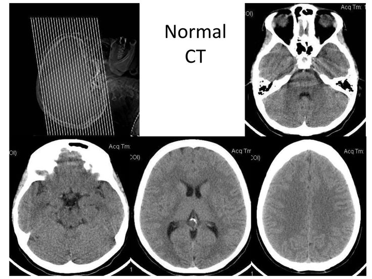 Normal CT BRAIN Ct Brain, Brain Lobes, Brain Images, Ct Scan, Medical College, Neurology, Radiology, Brain, For Free