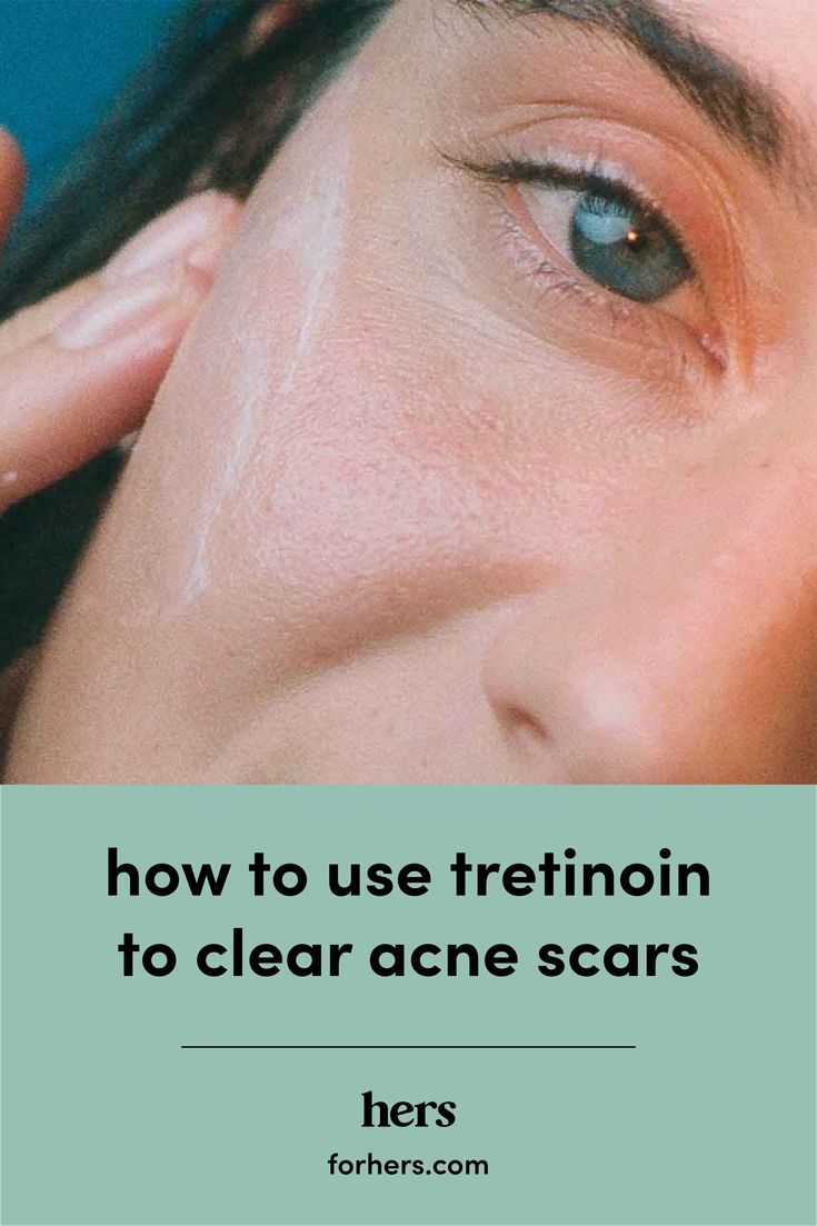 Retinoids Before And After, Tretinoin Before And After Acne, Tretinoin Acne, Tretinoin Before And After, Wellness Questions, Before And After Acne, Get Rid Of Acne, Rid Of Acne, How To Get Rid Of Acne