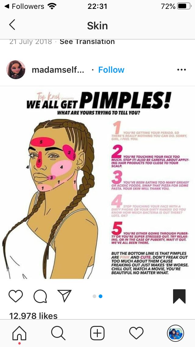 How To Get Rod Of Pimples Fast At Home, Pimple Area Meaning, Pimple Chart, Pimple Meaning, Bumps On Face, Peroxide For Acne, Pimple Solution, Blind Pimple, How To Reduce Pimples