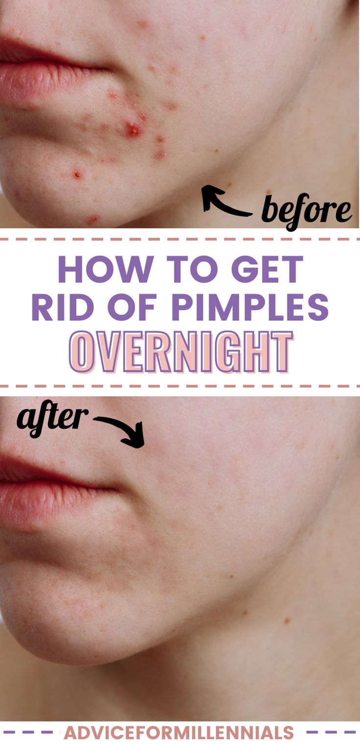 How to get rid of pimples overnight Overnight Pimple Remedies, Pimple Remedies, Zit Remedy, Get Rid Of Pimples Overnight, Rid Of Pimples Overnight, Huge Pimple, Dry Out Pimples, Back Acne Remedies, Big Pimple