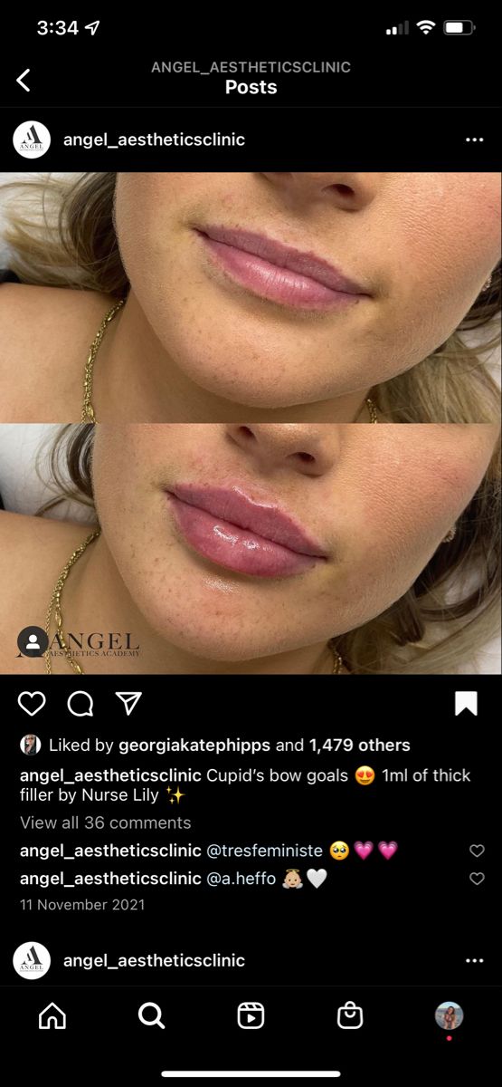 Hailey Beiber Lips Before And After, Lip Filler Before And After Round Lips, Natural Looking Filled Lips, Small Lip Injections Before And After, Light Lip Injections, Lip Fuller Shapes, M Shape Lips, Lip Fillers Cupids Bow, Lip Filler Inspiration Heart Shaped