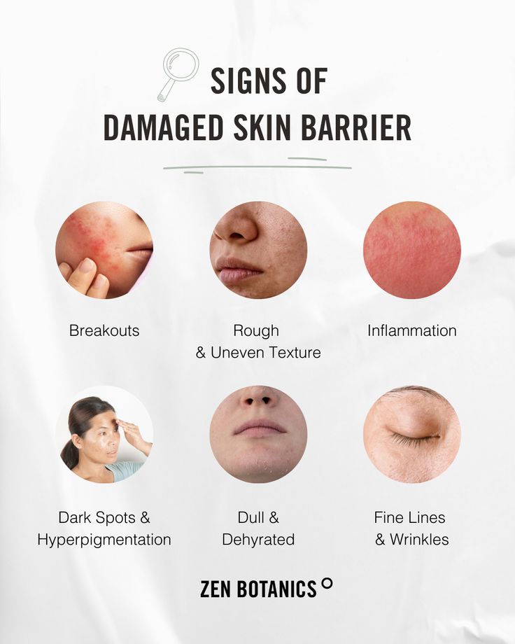 To Remove Pimples, Damaged Skin Barrier, Remove Pimples, Gross Things, Skin Facts, Bad Acne, Skin Care Business, Skin Aesthetics, How To Remove Pimples